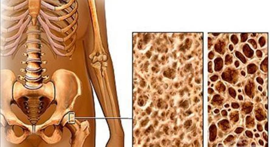  РЗИ-Смолян стартира информационна кампания за превенция на остеопорозата 