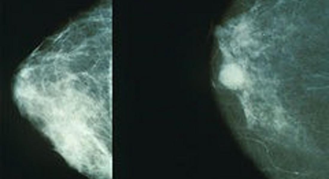 Изследват за рак на гърдата в РЗИ-Смолян