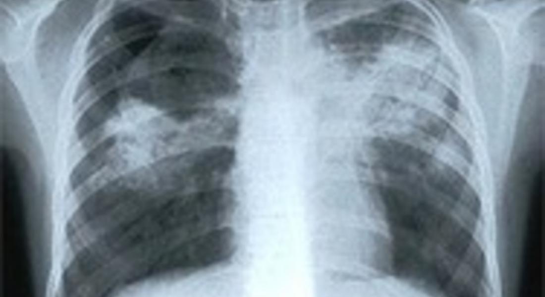 92-а болни от туберкулоза са открити през тази година