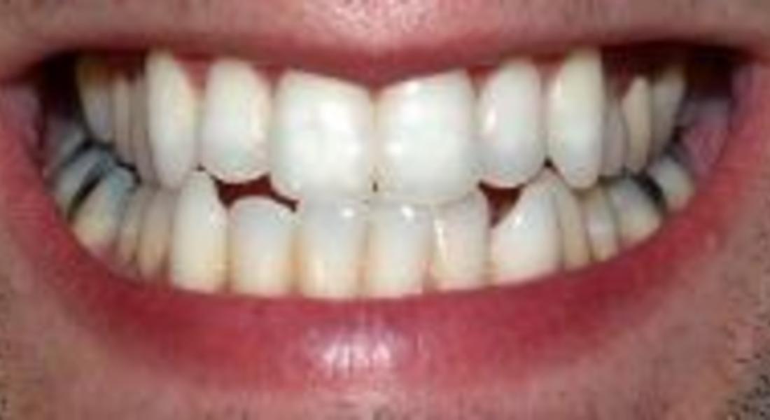 Безплатни прегледи на зъбите през октомври 