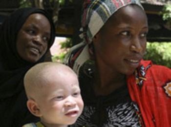 10 000 албиноси се укриват в Източна Африка