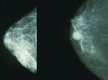 Почти 100 жени се прегледаха за рак на гърдата в Смолян