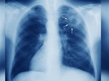 Безплатни прегледи за туберкулоза ще се извършват в МБАЛ - Смолян