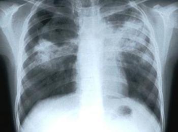 Безплатни прегледи за туберкулоза организира МБАЛ – Смолян