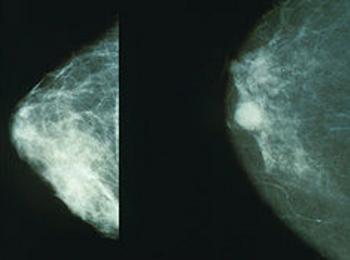 Започва кампания за превенция на рака на гърдата