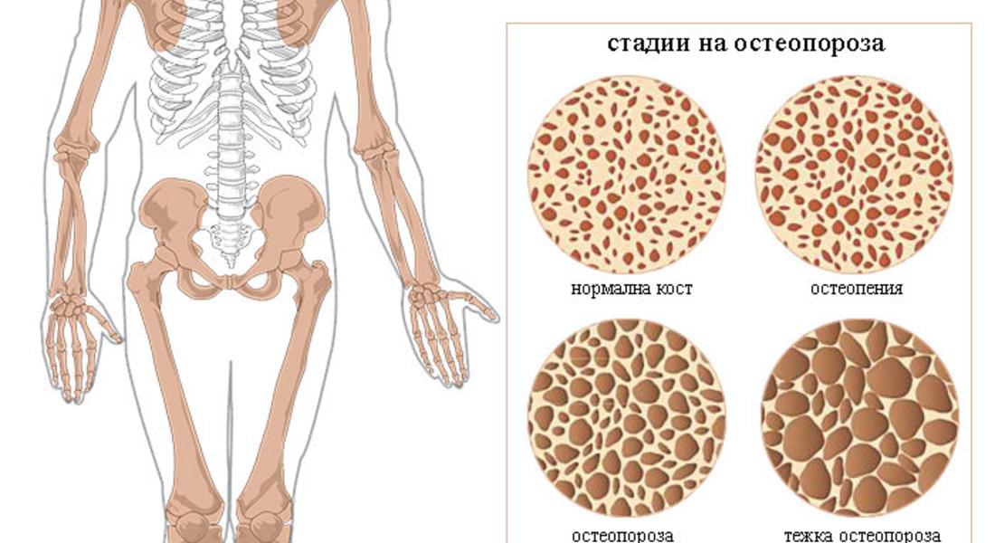 „Да подобрим костното здраве“ е мотото на световния ден за борба с остеопорозата  2022г.